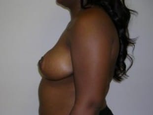 Breast Reduction Paramus, NJ 1