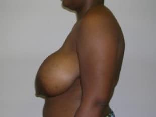 Breast Reduction Paramus, NJ 1