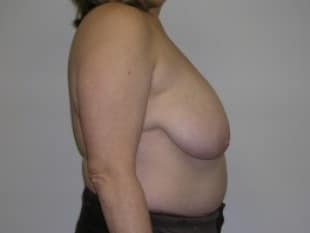 Before Image: Breast Reduction Paramus, NJ 2 - other
