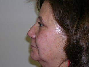 After Image: Blepharoplasty - other