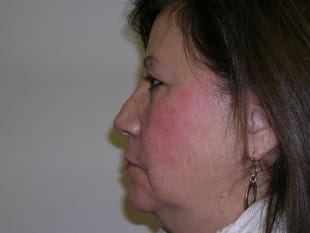 Before Image: Blepharoplasty - other