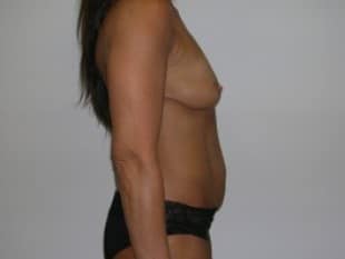 Breast lift with implants Paramus, NJ