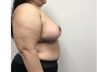 After Image: Breast Reduction, Paramus, NJ - other