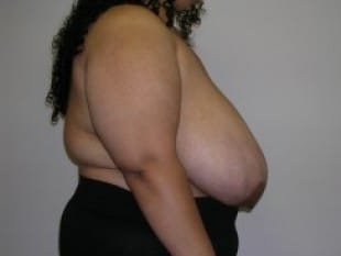 Before Image: Breast Reduction, Paramus, NJ - other