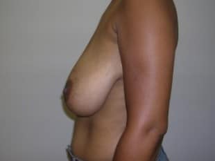 Before Image: Breast Reduction Paramus, NJ - front