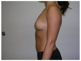 Breast Augmentation