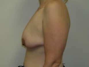 Breast Lift with Implants Paramus, NJ