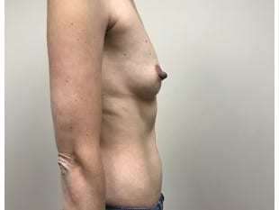 Before Image: Breast Augmentation Paramus, NJ - front