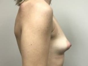 Before Image: Breast Augmentation, Paramus, NJ - other