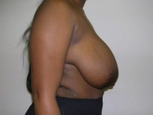 Before Image: Breast Reduction, Paramus, NJ - other