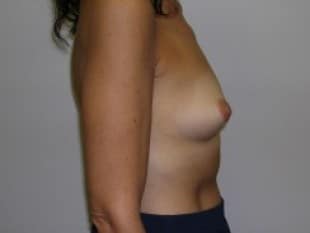Before Image: Breast Augmentation, Paramus, NJ - other