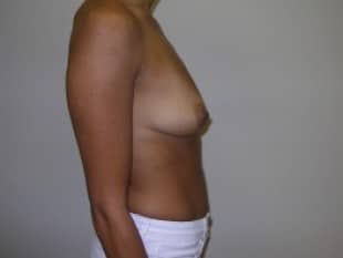 Breast Augmentation Bergen County Paramus, NJ