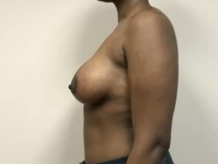 Breast Lift with Implants, Paramus, Bergen County, NJ