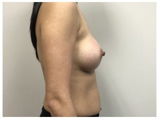 Breast Augmentation, Paramus, New Jersey