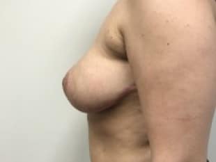 Breast Reduction Paramus, NJ