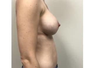 Breast Augmentation, Paramus , NJ
