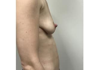 Breast Augmentation, Paramus , NJ