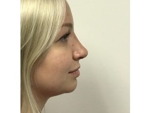 Rhinoplasty Paramus, NJ