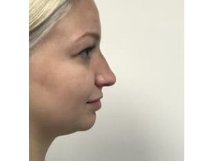 Rhinoplasty Paramus, NJ