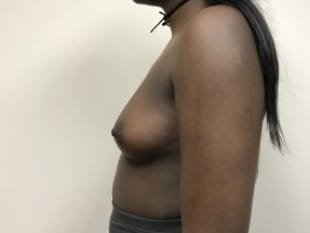 Breast Augmentation Paramus, NJ