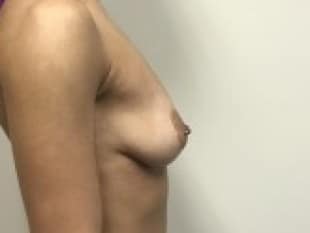 Breast Augmentation, Paramus Bergen County