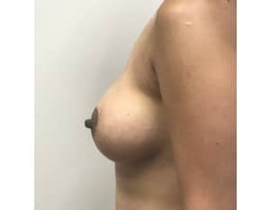Breast Augmentation, Paramus, Bergen County