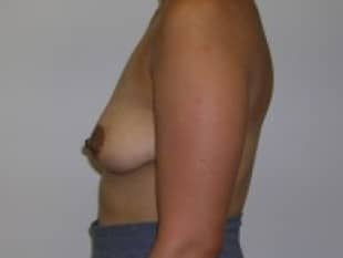 Breast Augmentation, Paramus, Bergen County