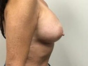Breast Augmentation Paramus, NJ