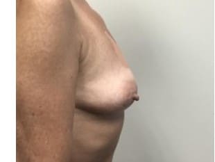 Breast Augmentation Paramus, NJ