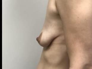 Breast Lift with Implants Paramus, NJ