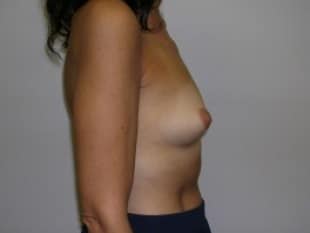 Breast Augmentation Paramus, NJ
