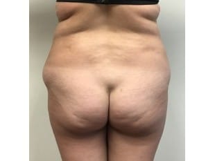Liposuction Paramus, NJ
