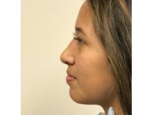 After Image: Rhinoplasty Paramus, NJ - other