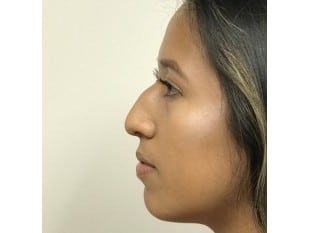 Before Image: Rhinoplasty Paramus, NJ - other