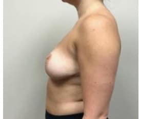 Breast Reduction Paramus, NJ