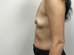 Breast Augmentation Paramus, NJ