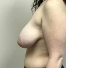 Breast Reduction Paramus, NJ