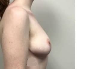 Breast Reduction Paramus NJ