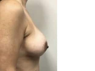 Breast Lift with implants, Paramus, NJ