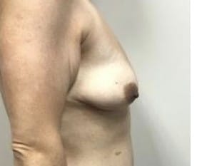 Breast Lift with implants, Paramus, NJ