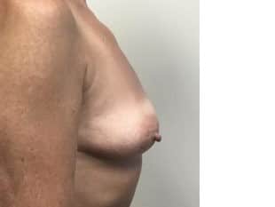 Breast Augmentation Paramus, NJ