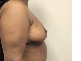 Breast Reduction Paramus, NJ