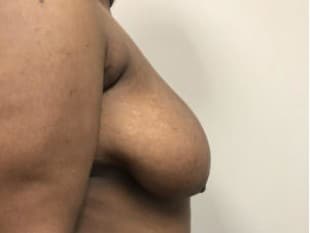 Breast Reduction Paramus, NJ