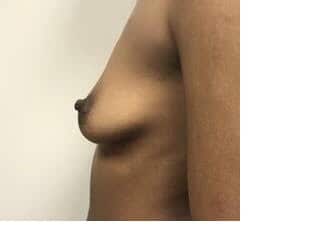 Breast Augmentation, Bergen County, Paramus NJ