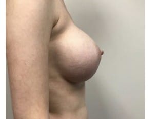 Breast Augmentation Paramus, NJ