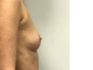 Breast Augmentation Paramus, NJ