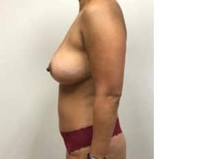 Breast Augmentation Paramus, NJ