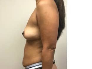 Breast Augmentation Paramus, NJ
