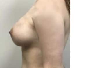 Breast Augmentation, Paramus, NJ