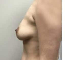 Breast Augmentation, Paramus, NJ
